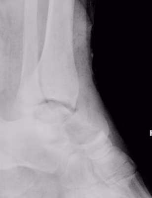Hawkins 4 Talar Neck Fracture