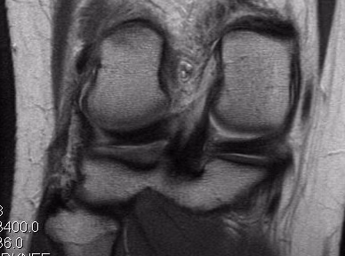Knee LCL Midsubstance Tear PLC injury