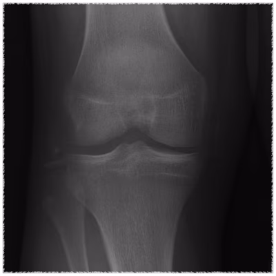 LCL Bony Avulsion
