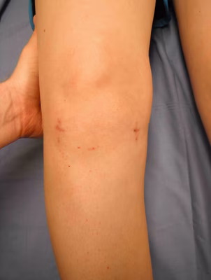 LCL Instability Varus