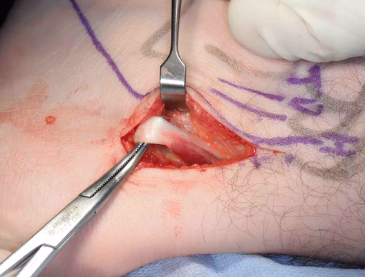 Os Trigonum FHL Accessory Muscle