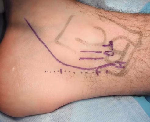 Os Trigonum Skin Marking