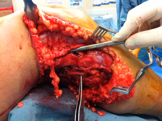 Lateral Approach 1