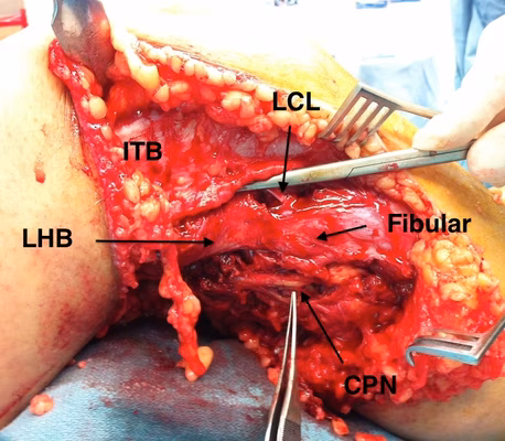 Lateral Approach 2