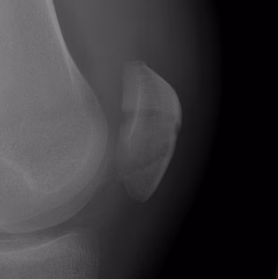 Undisplaced patella fracture
