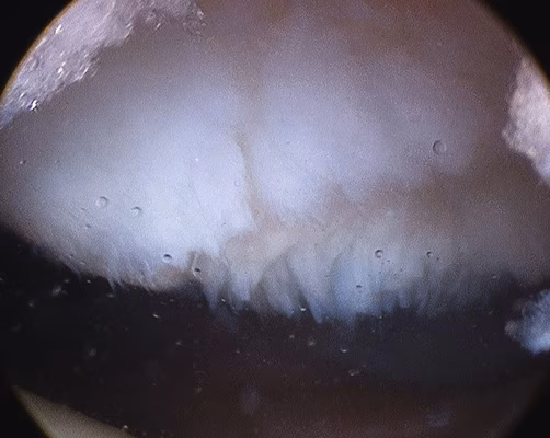 Patella Grade 3 Arthroscopy