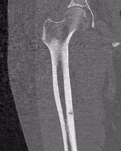 Stress Fracture Medial