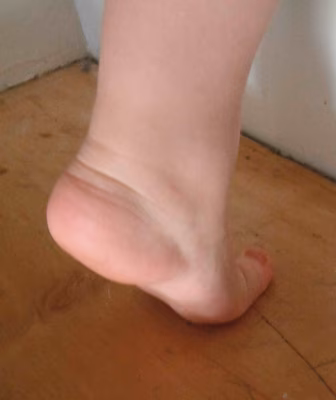 Single Heel Raise Arch Restoration