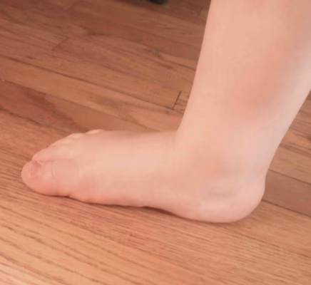 Physiological Flatfoot
