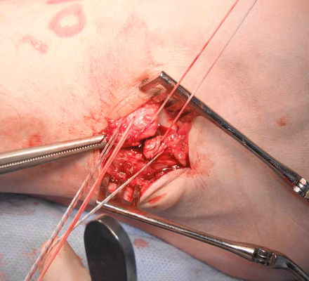 2 Sutures to Close Interval