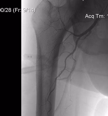 Angiogram Proximal Femur0001