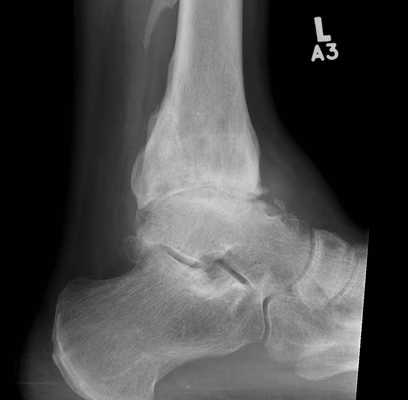 Ankle OA Lateral Xray