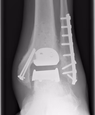 Ankle OA Arthroplasty AP