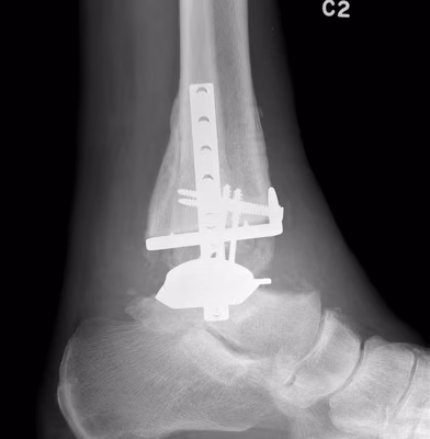 Ankle Arthroplasty post ORIF lateral