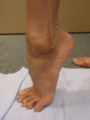 Peroneal Tendon Dislocation 1