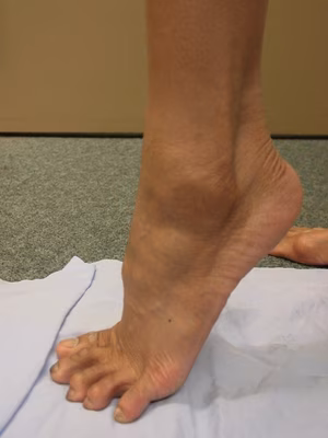 Peroneal Dislocation 2