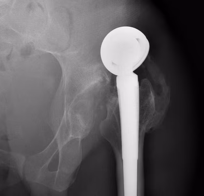 Bipolar Dislocation
