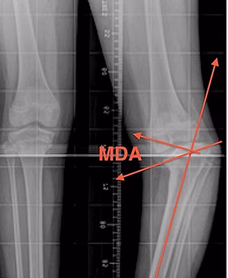 Blounts Metaphyseal Diaphyseal Angle