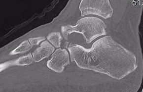 Calcaneum Anterior Process Non Union