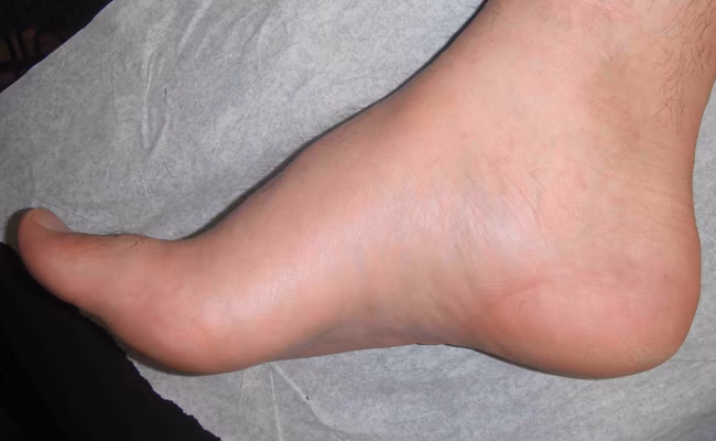 Cavus Foot