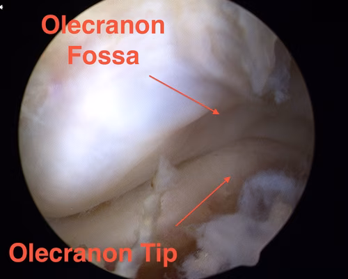 Elbow Arthroscopy Posterior Compartment