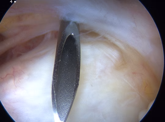 Elbow Scope Anterolateral Portal