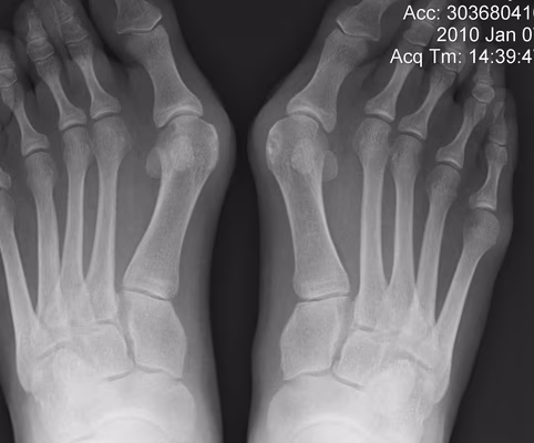 Juvenile Hallux Valgus