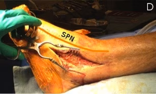 Anterolateral Approach Ankle