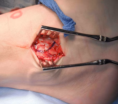 Lateral Ligament Repair Flap Incisions