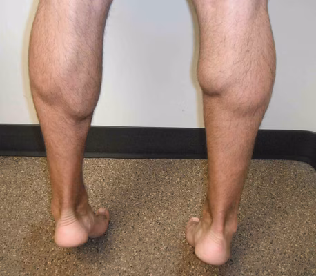 Medial Head Gastrocnemius Rupture