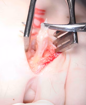 Mortons Neuroma