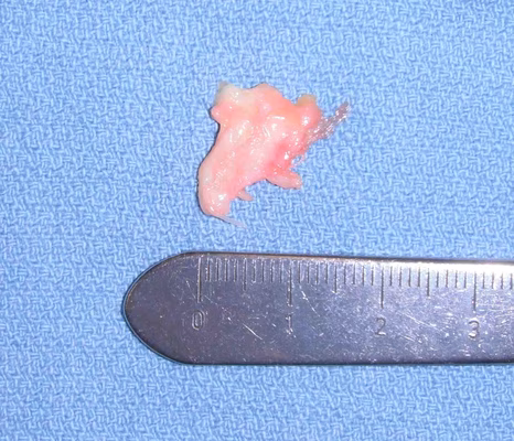 Mortons Neuroma