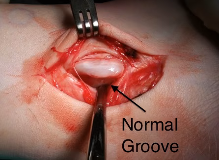 Normal Groove