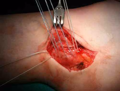 Sutures Passed 2