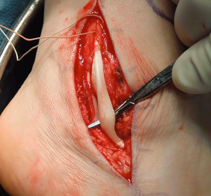 Peroneals Intra-operatively