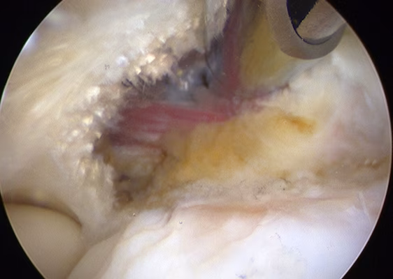 Arthroscopic Tennis Elbow Release 2