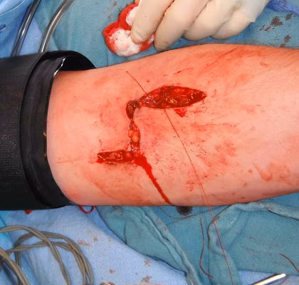 Biceps Approach