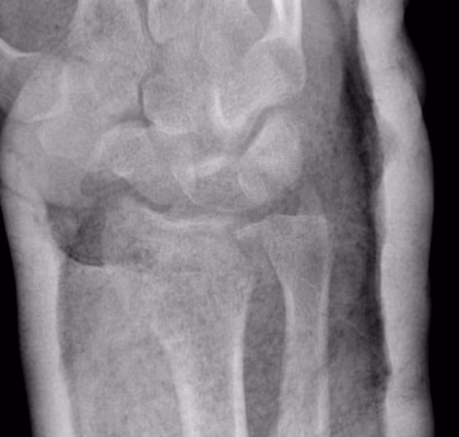 DRUJ Fracture