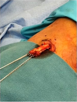 Distal Biceps Tendon with Endobutton