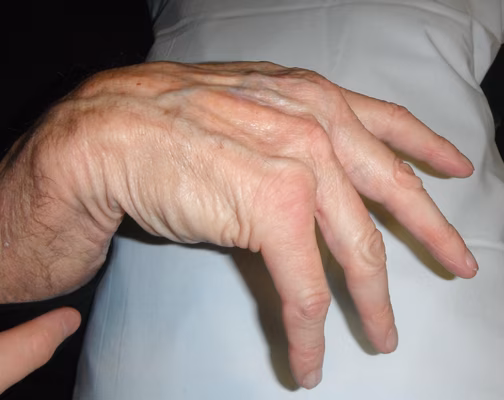Dropped Fingers 1