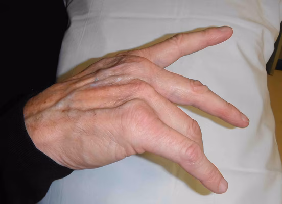 Dropped Fingers
