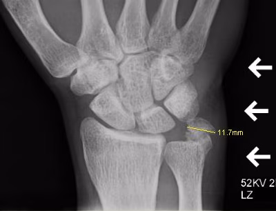 ECU Calcific Tendonitis