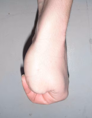 Eichoff Test