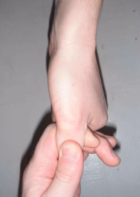 Finkelstein Test