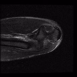 Biceps Partial tear