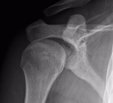 Glenoid Fracture