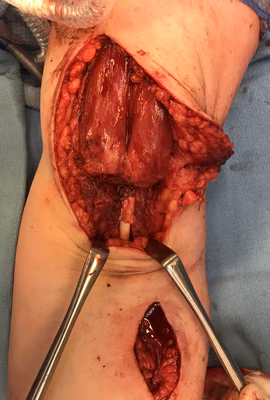 Two incision allograft reconstruction