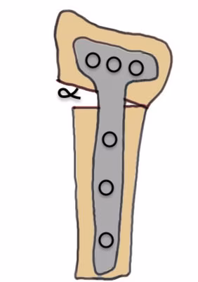 volar osteotomy