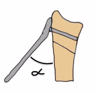 Volar osteotomy