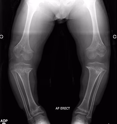 Achondroplasia